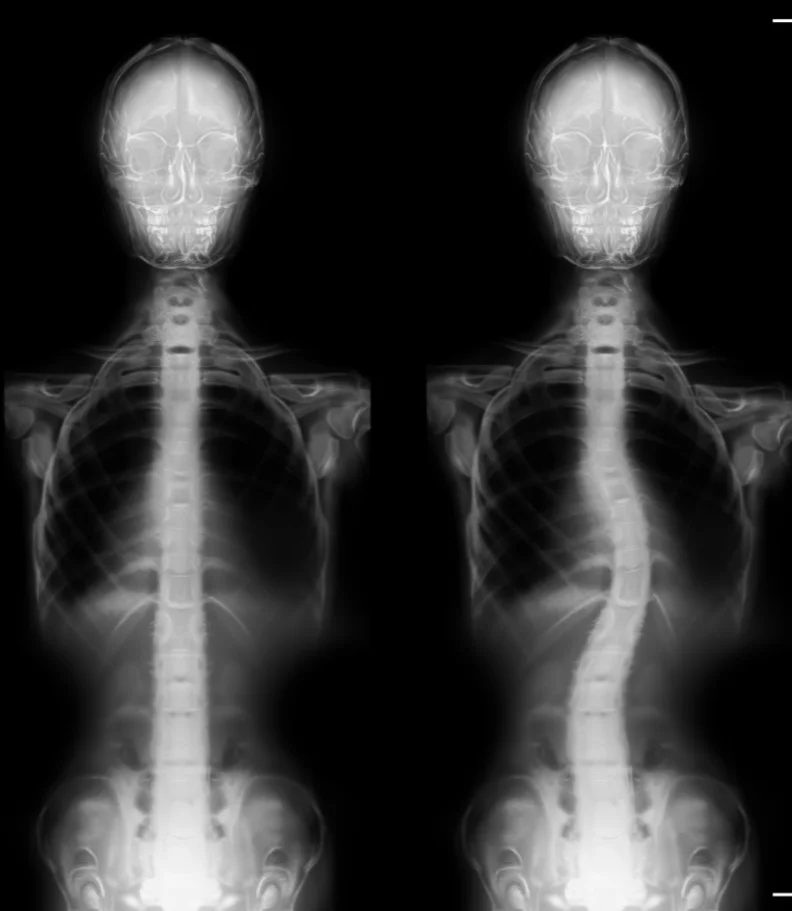 scoliosis Greenville SC